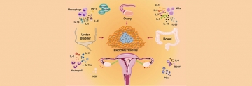 Endometriozis & Kronik Pelvik Ağrı